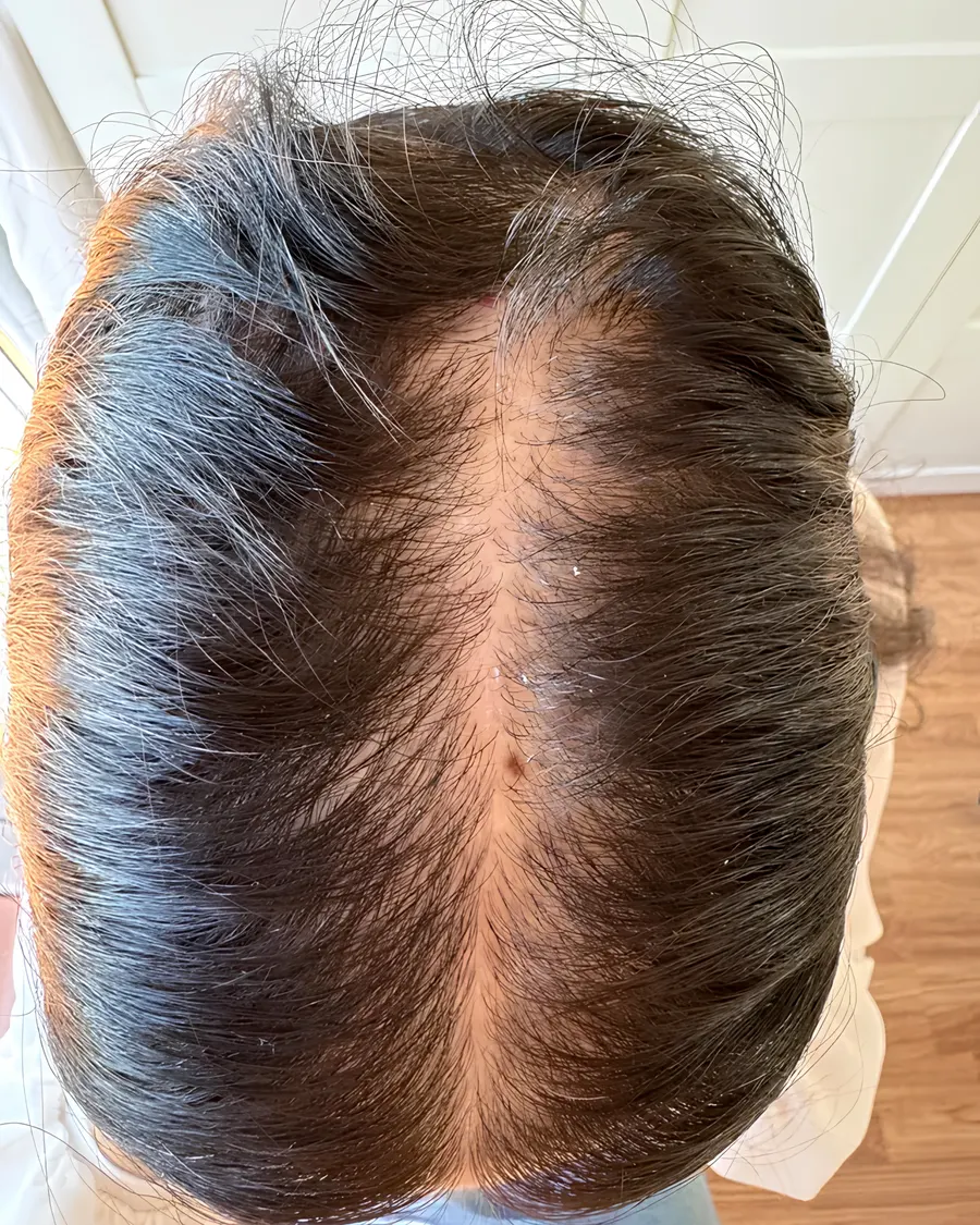 Alopecia management at Cinch Clinics